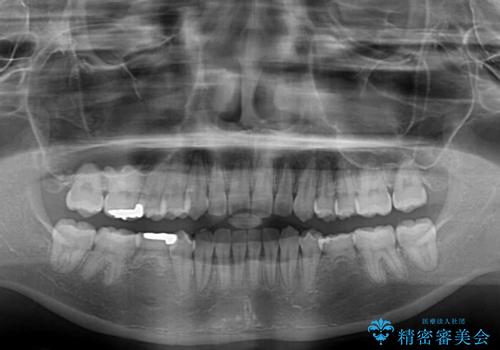 楽してクロスバイトを治したい ワイヤー装置による矯正治療の治療後