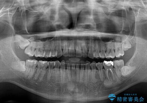 【モニター】前歯のクロスバイトと隙間を改善 インビザラインによる矯正治療の治療後