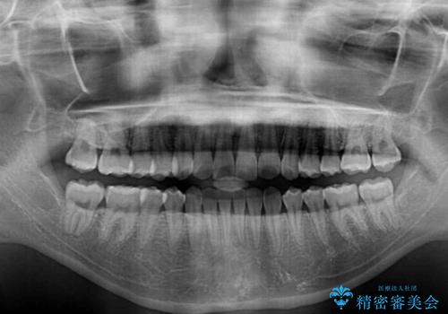【モニター】インビザラインで口を閉じやすくの治療後