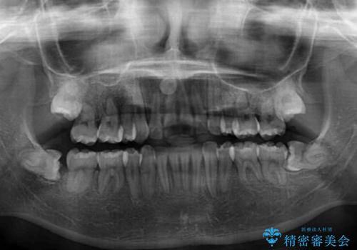 骨格的なズレをカムフラージュ 抜歯矯正で咬み合わせを改善の治療後
