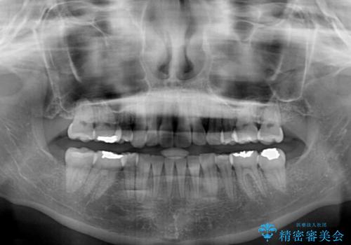 デコボコで飛び出した前歯 ワイヤー装置による抜歯矯正の治療後