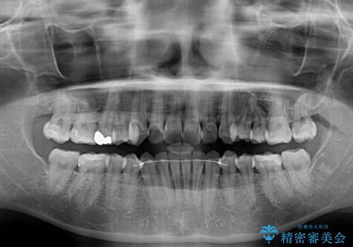デコボコ歯列をきれいに インビザラインによる矯正治療の治療後