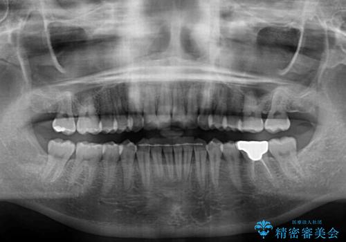 出産をしながら歯列を整える インビザラインによる矯正治療の治療後