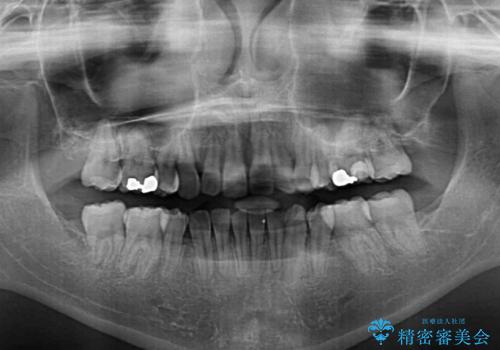 著しい八重歯を短期間で改善 ワイヤー装置による抜歯矯正の治療後