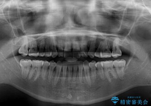 補助装置を併用したインビザラインでの八重歯の抜歯矯正の治療後