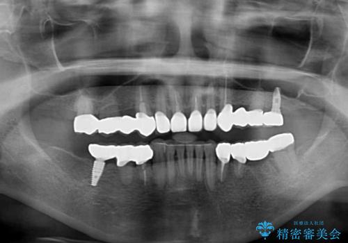 銀歯や入れ歯で汚い歯をきれいにしたい　総合歯科治療の治療後