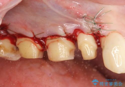 歯周外科で達成する安定したクラウン周囲の歯肉環境の治療前
