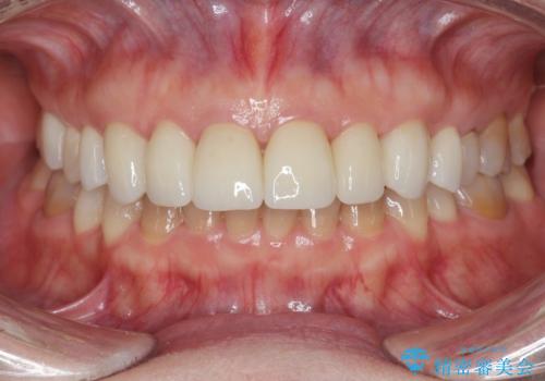 劣化してきた前歯ラミネートをジルコニアクラウンへの治療後