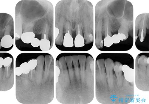 銀歯や入れ歯で汚い歯をきれいにしたい 総合歯科治療の治療前