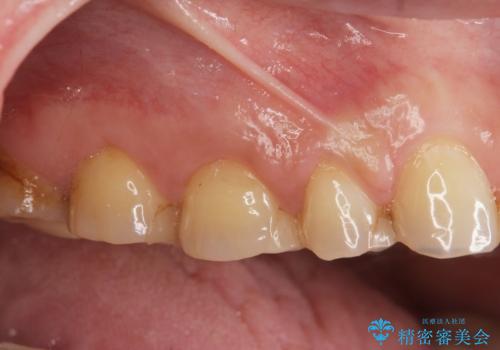 歯周外科で達成する安定したクラウン周囲の歯肉環境の症例 治療前