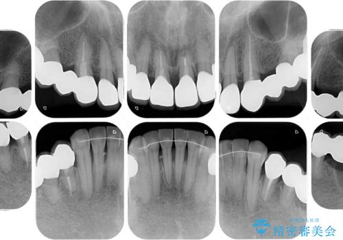 銀歯や入れ歯で汚い歯をきれいにしたい 総合歯科治療の治療後