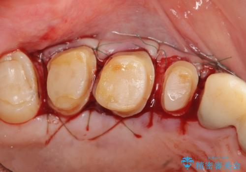 歯周外科で達成する安定したクラウン周囲の歯肉環境の治療前
