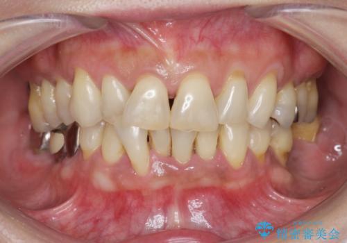 前歯のすれ違いによる歯周病を矯正治療で改善の症例 治療前