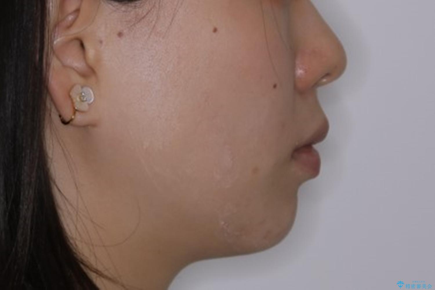 前歯の重なりは奥歯のズレが原因:まとめてインビザラインで治すの治療後(顔貌)