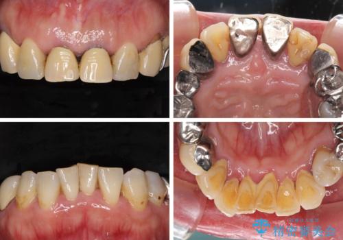 銀歯や入れ歯で汚い歯をきれいにしたい 総合歯科治療の治療前