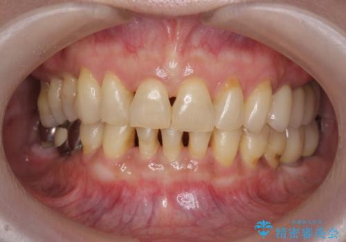 前歯のすれ違いによる歯周病を矯正治療で改善の症例 治療後