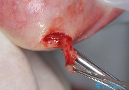 唇がたびたび腫れる　粘液嚢胞の摘出の治療中