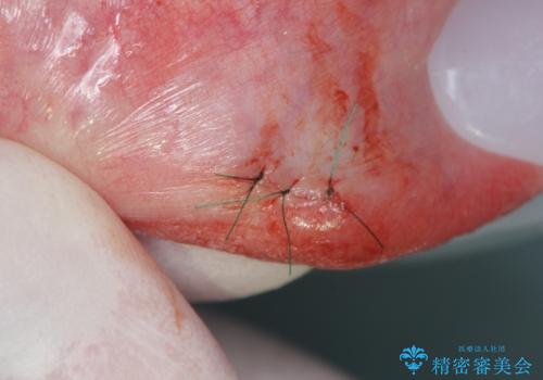 唇がたびたび腫れる 粘液嚢胞の摘出の治療中