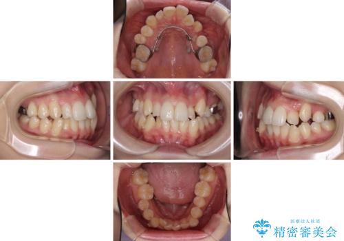 補助装置を併用したインビザラインでの八重歯の抜歯矯正の治療中