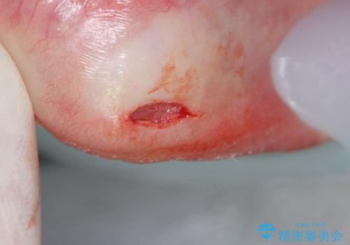 唇がたびたび腫れる 粘液嚢胞の摘出の治療中