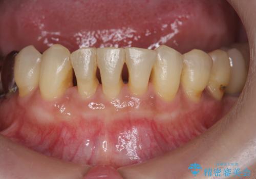 前歯のすれ違いによる歯周病を矯正治療で改善の治療後