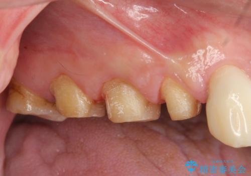 歯周外科で達成する安定したクラウン周囲の歯肉環境の治療前