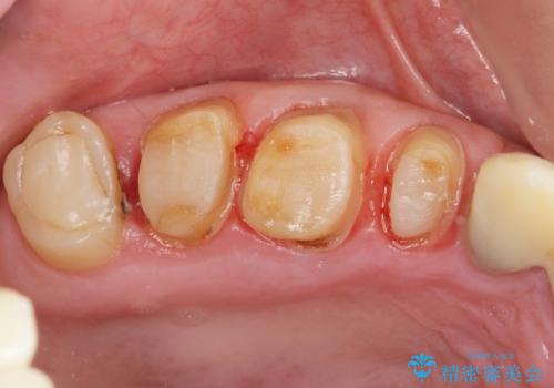 歯周外科で達成する安定したクラウン周囲の歯肉環境の治療前