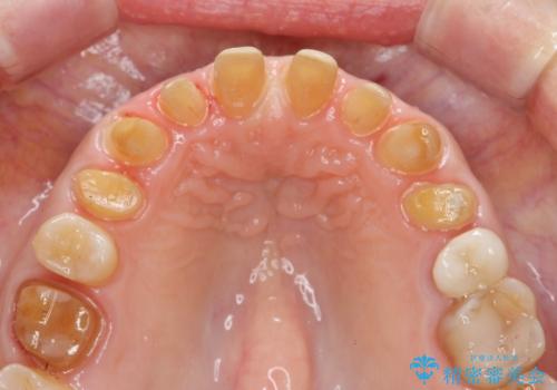 劣化してきた前歯ラミネートをジルコニアクラウンへの治療中