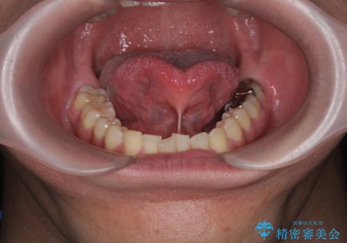 [ 舌小帯の長い付着 ]   舌の動きが悪く話しづらいの治療前