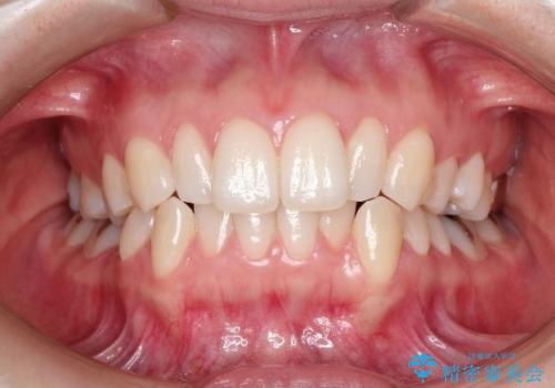 【前歯のがたつきでお悩みの方必見】インビザライン矯正の症例