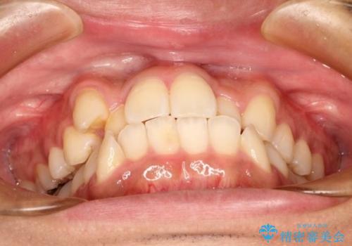 【八重歯・がたつきでお悩みの方必見】抜歯矯正症例(審美ワイヤー矯正)の治療前