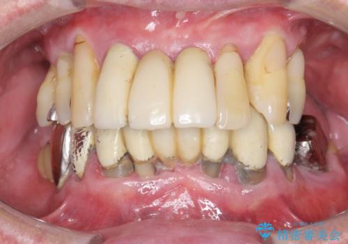 [ インプラントオーバーデンチャー ] インプラント+入れ歯・ブリッジで作るしっかりとした咬合状態の症例 治療前