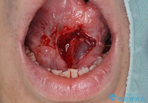 [ 舌小帯の長い付着 ]   舌の動きが悪く話しづらいの治療中