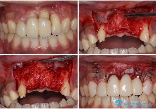 事故で抜歯となった前歯　ブリッジやインプラントによる補綴治療の治療中