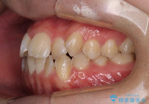 非抜歯ワイヤー装置による、短期間での矯正治療の治療前