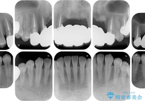 事故で抜歯となった前歯 ブリッジやインプラントによる補綴治療の治療後