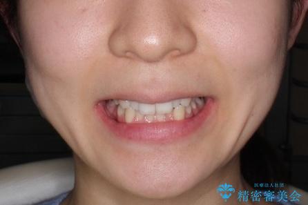 【前歯のがたつきでお悩みの方必見】インビザライン矯正の症例の治療前(顔貌)