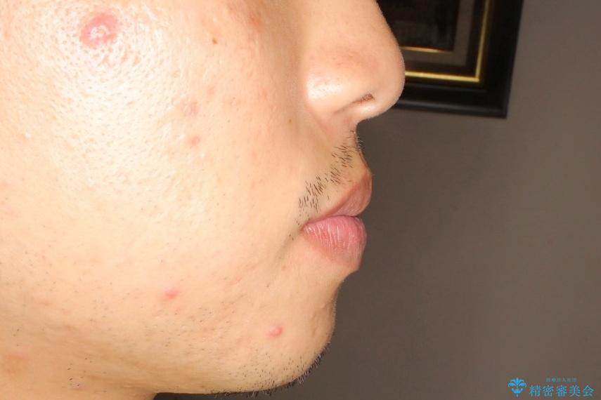 【八重歯・がたつきでお悩みの方必見】抜歯矯正症例(審美ワイヤー矯正)の治療前(顔貌)