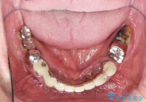 [ インプラントオーバーデンチャー ] インプラント+入れ歯・ブリッジで作るしっかりとした咬合状態の治療前