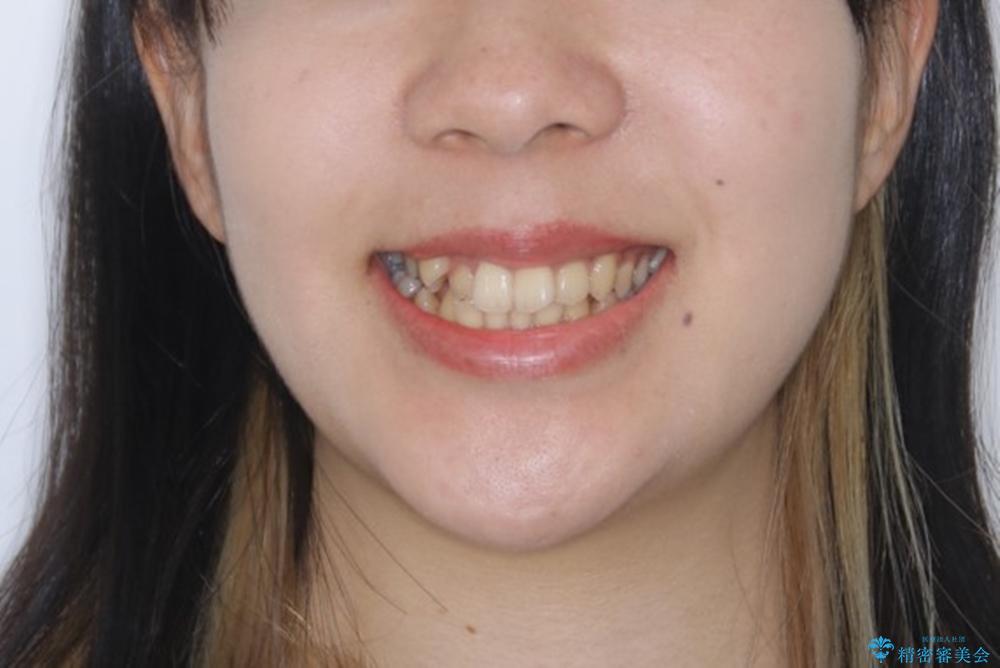 八重歯の解消とインプラントの下準備をインビザラインでの治療前（顔貌）