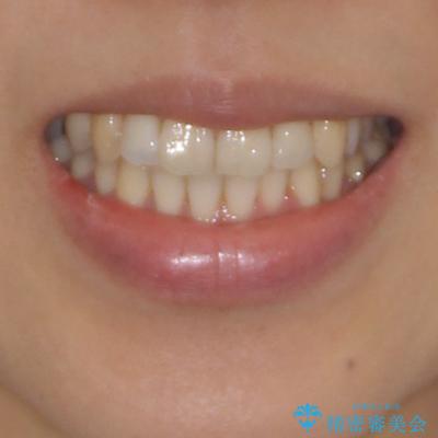 後戻りの再矯正治療と欠損部の補綴治療の治療前(顔貌)