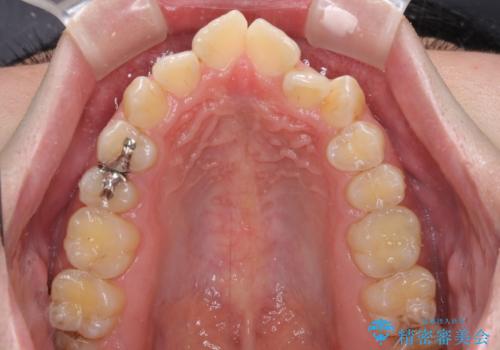 非抜歯ワイヤー装置による、短期間での矯正治療の治療前