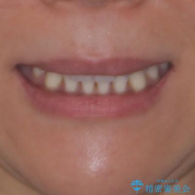 抜歯矯正の後戻りをインビザライン・ライトで解消の治療前（顔貌）