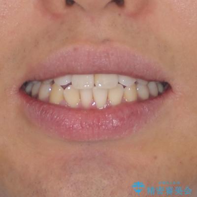 インビザラインで奥歯の咬み合わせと前歯のデコボコを改善の治療前(顔貌)