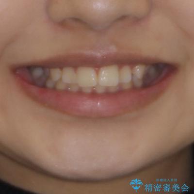 カリエール・ディスタライザーとインビザラインを用いた奥歯の咬み合わせ改善の治療前（顔貌）