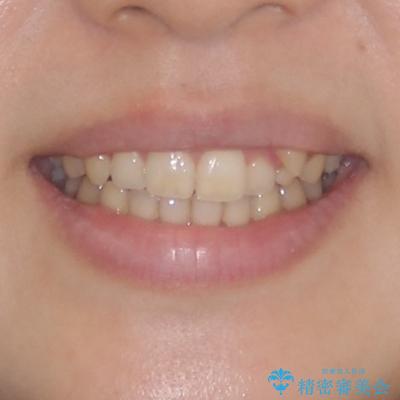 気になる残存乳歯と八重歯　ワイヤー矯正を併用したインビザライン治療の治療前（顔貌）