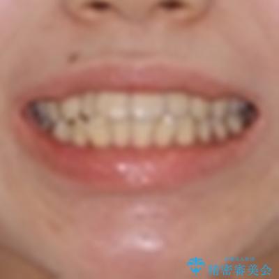 短期間で口元の突出感を改善　ワイヤー装置での抜歯矯正の治療前（顔貌）