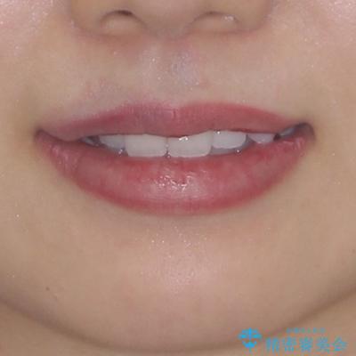 八重歯を改善 目立たないワイヤー装置での矯正治療の治療前(顔貌)