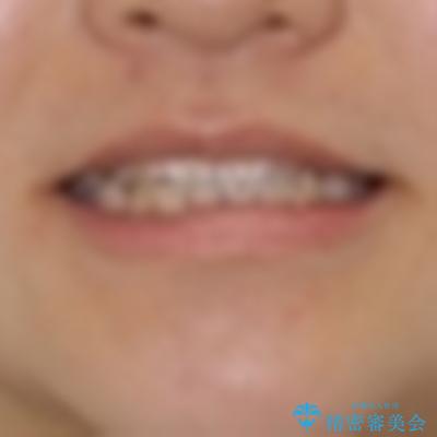 むし歯になりやすい奥歯 補助装置で一気に解決の治療前(顔貌)