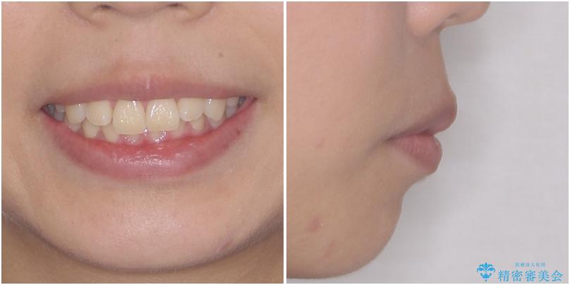 上顎前突 目立たないワイヤー装置での抜歯矯正の治療前(顔貌)